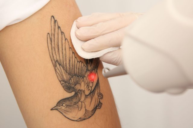 rimozione tatuaggi con laser